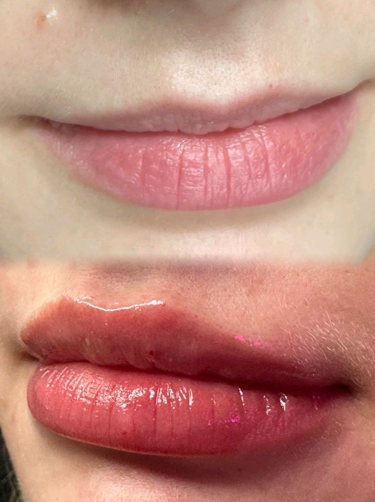No-Needle Lip Filler