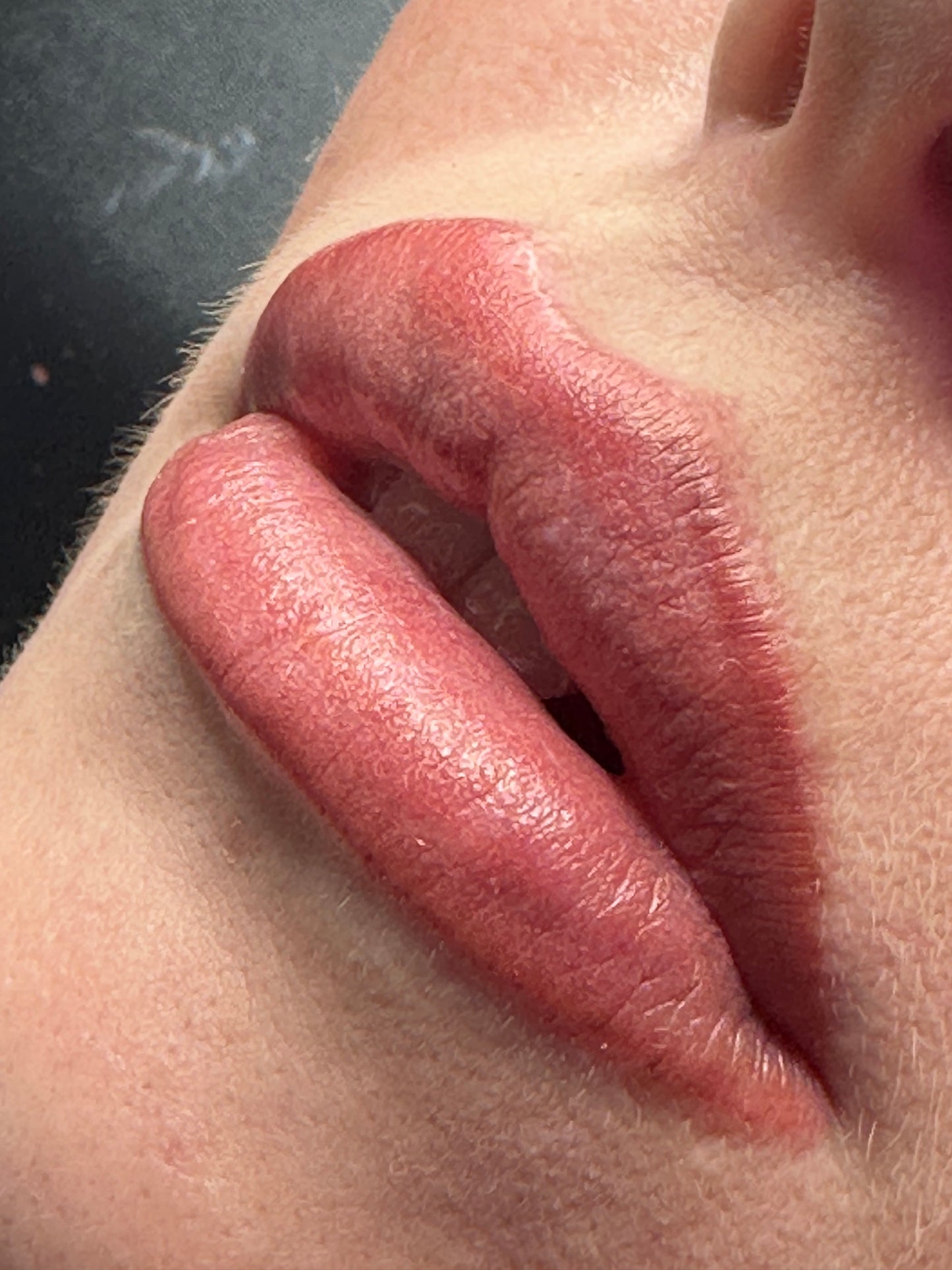 Frozen Lips